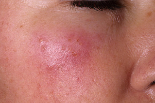 Herpes na obrazu