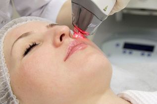 Proces podmlađivanja kože lica frakcionim laserom