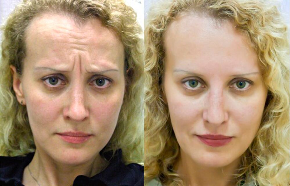 prije i poslije korištenja masažera za podmlađivanje ltza fotografija 1
