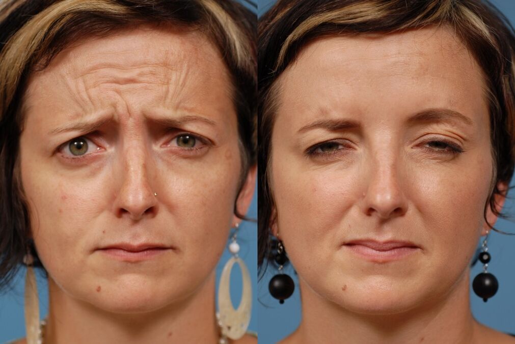 prije i poslije korištenja masažera za podmlađivanje ltza fotografija 2