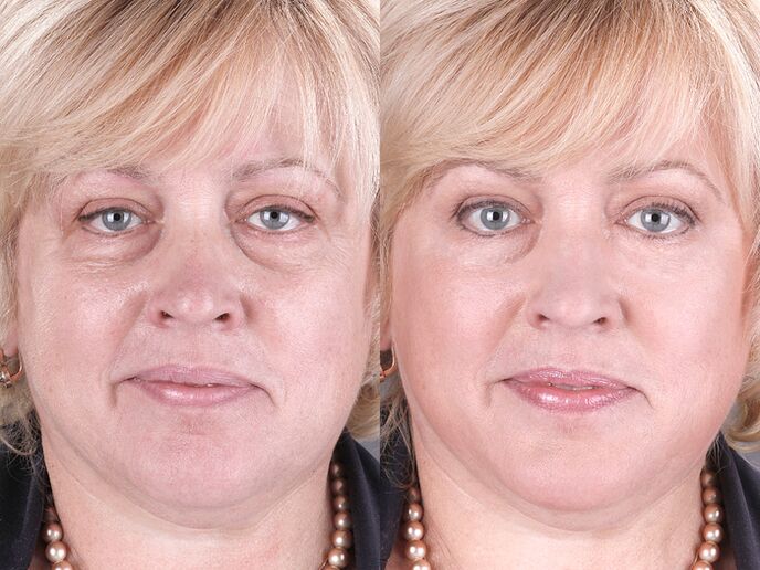prije i poslije korištenja masažera za podmlađivanje ltza fotografija 3