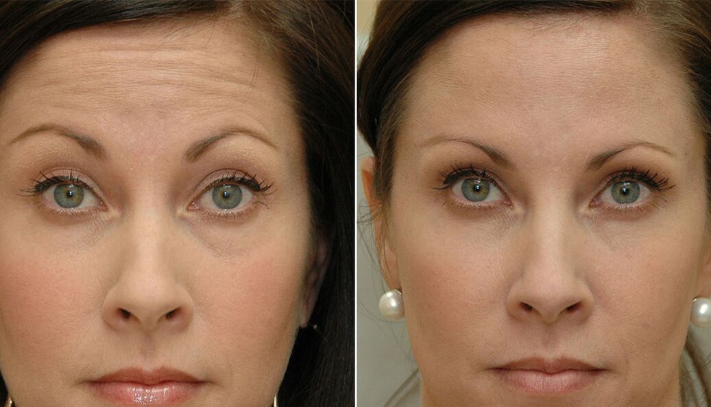 prije i poslije korištenja masažera za podmlađivanje ltza fotografija 4