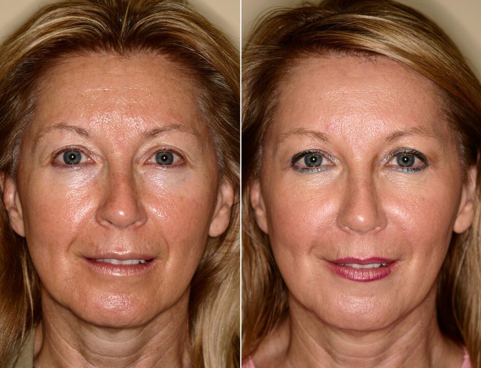 prije i poslije korištenja masažera za podmlađivanje ltza fotografija 5