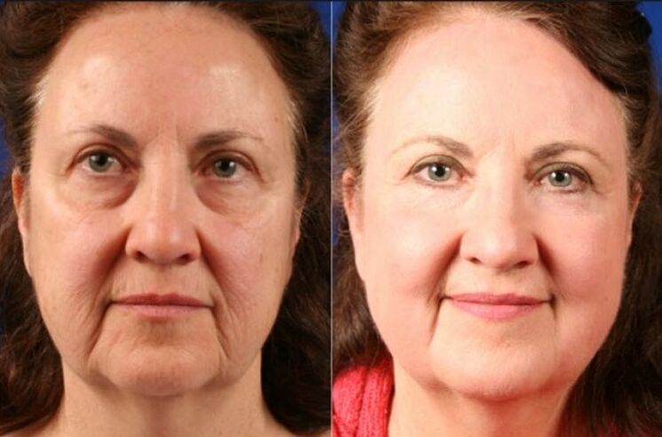 prije i poslije korištenja masažera za podmlađivanje ltza fotografija 6