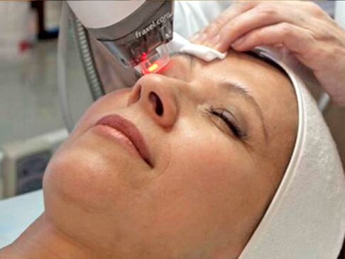 lasersko podmlađivanje kože oko očiju