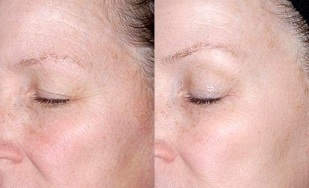 podmlađivanje kože oko očiju prije i nakon fotografija
