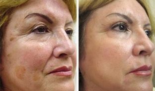 frakcijsko podmlađivanje kože prije i poslije fotografija