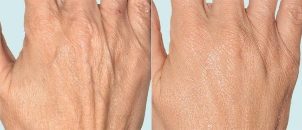 Koža ruku prije i nakon frakcijske terapije
