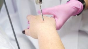 Lasersko podmlađivanje kože ruku